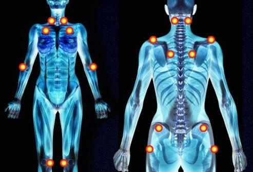 Fibromyalji Nedir? Fibromyalji Tedavisi Nasıl Olur? 