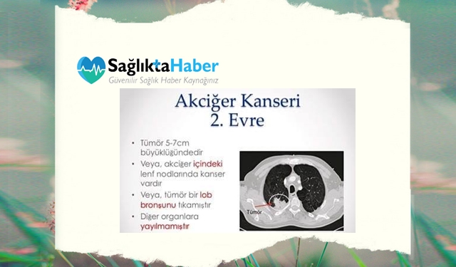 Akciğer Kanseri 2. Evresi Tehlikeli mi?