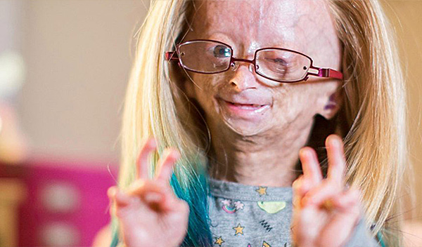 Progeria Ölümcül müdür?