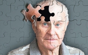 Alzheimer hastalığı nedir nasıl olur? 