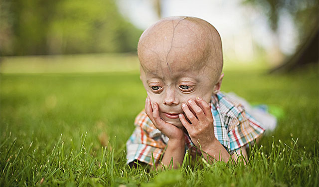 Progeria (Erken Yaşlanma Hastalığı) Nedir?