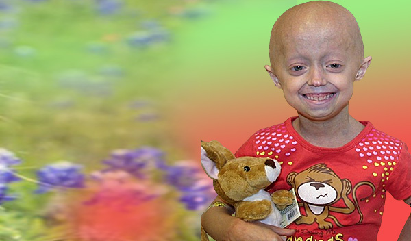 Progeria (Erken Yaşlanma) Nasıl Tedavi Edilir?