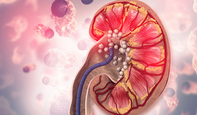 Böbrek taşı tedavisi nasıl olur?